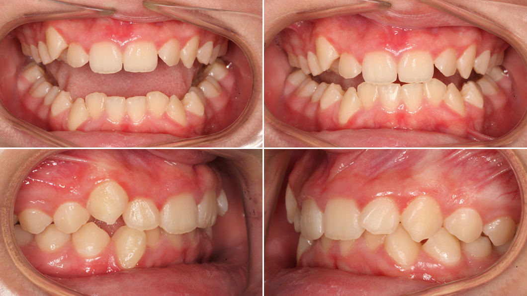 Выраженная скученность Выраженная скученность