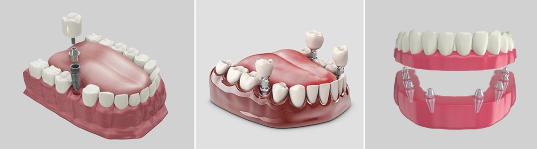 Варианты имплантации: один зуб, несколько зубов, полная адентия