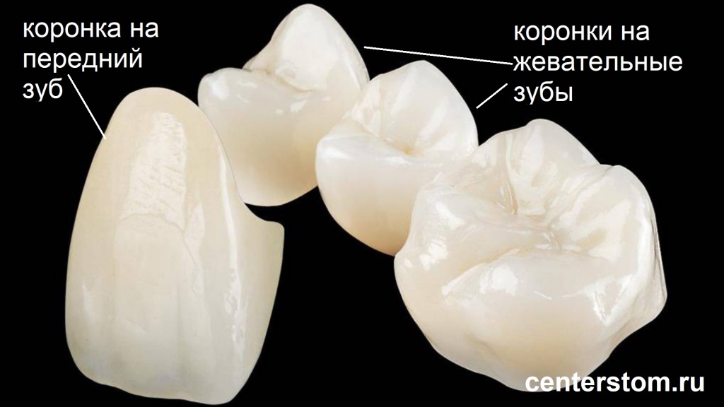 Керамические коронки на зубы