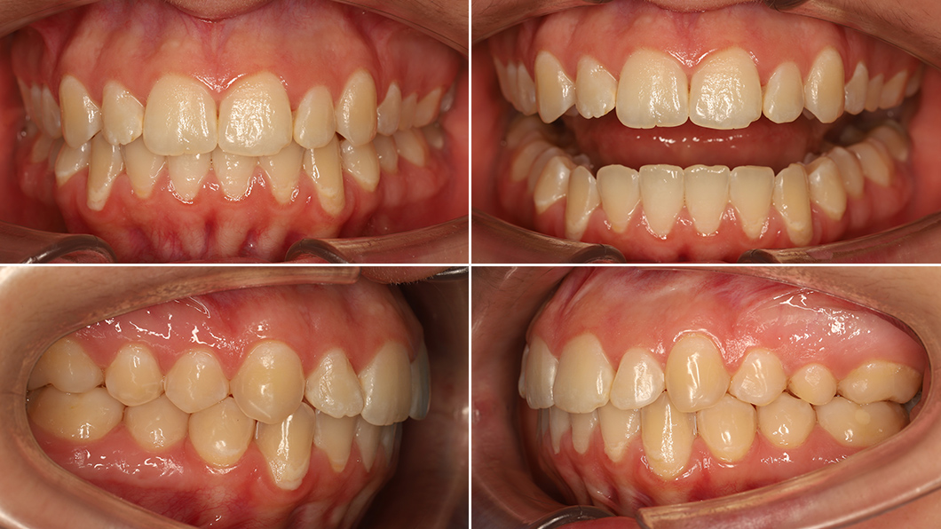 Ровные красивые зубы