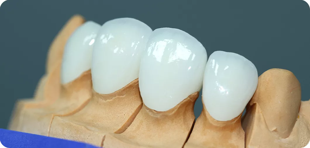 реставрация зубов винирами