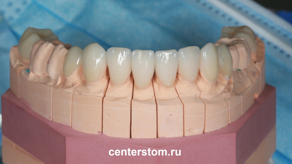 Сначала виниры примеряются на точной модели зубов пациента