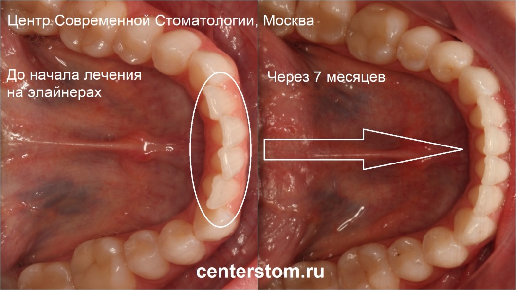 Вид зубов нижней челюсти до и после лечения на элайнерах