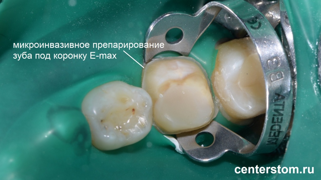 Подготовка зуба шестерки к протезированию коронкой E-max. Центр Современной Стоматологии, Москва