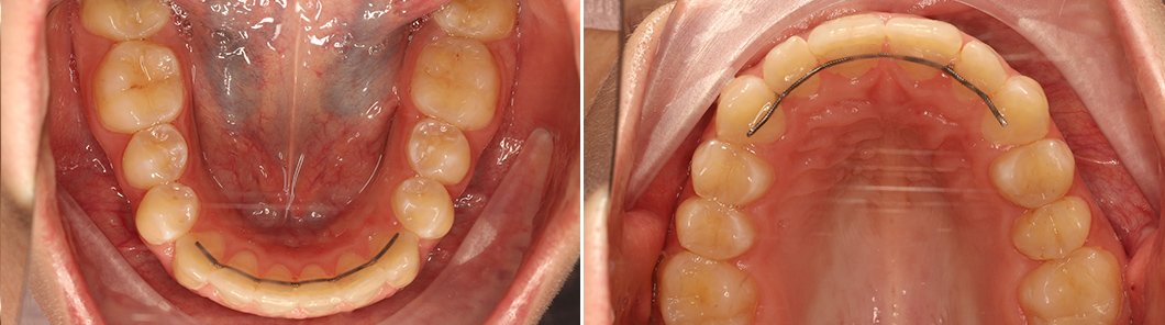 Установка ретейнеров