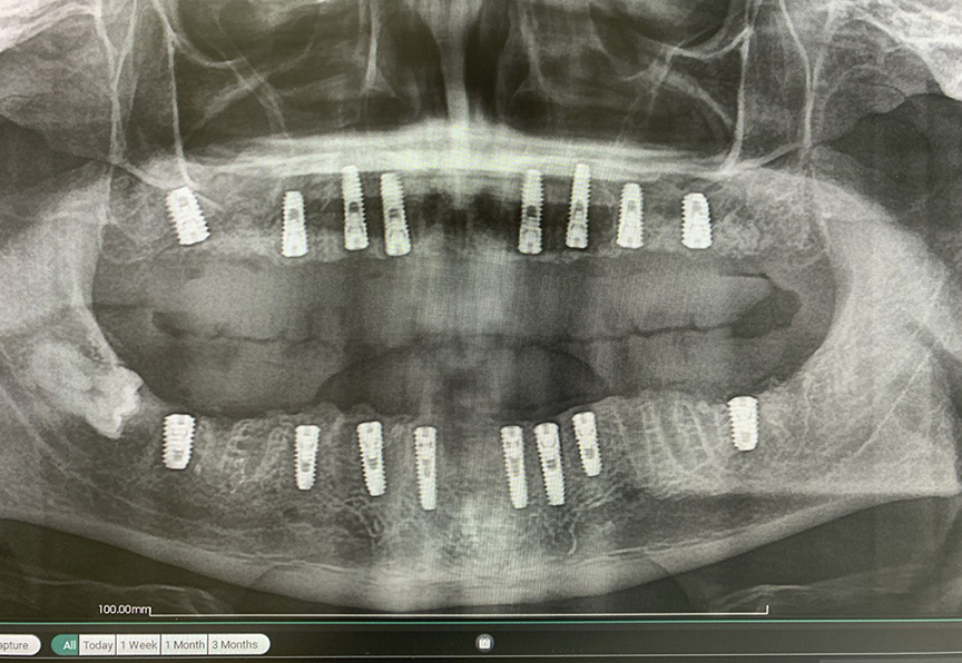 Снимок имплантов