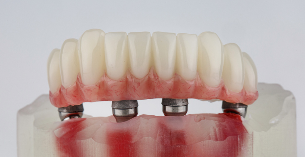 Схема протезирования All-on-4 на челюсти