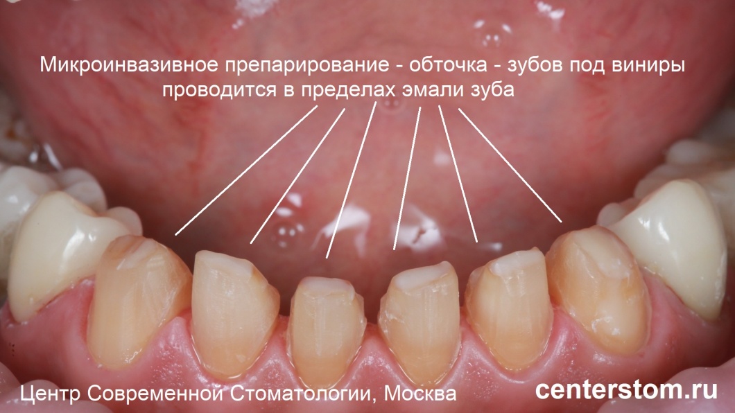 На фото - препарированные зубы. Обточка проводится в пределах эмали зуба.