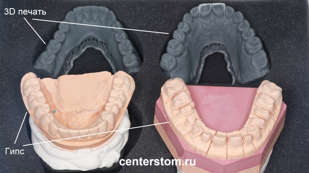 3Д модели зубов и гипсовые слепки до и после обточки зубов. Готовимся к временному и постоянному протезированию