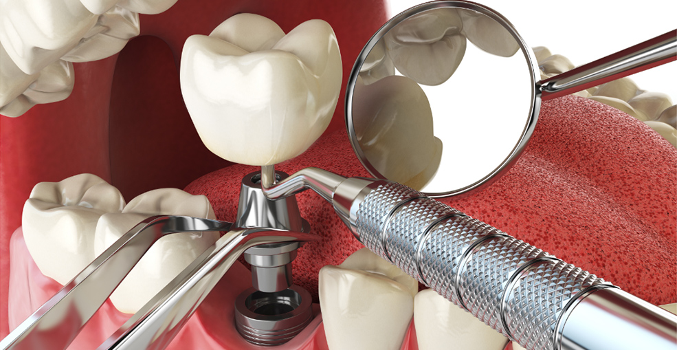 Схема одномоментной имплантации зуба в лунку