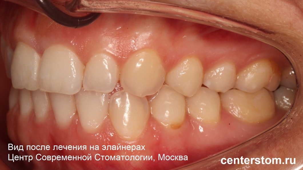 Вид зубов после лечения на элайнерах. Диагноз - перекрестный прикус, скученность зубов. Центр Современной Стоматологии, Москва