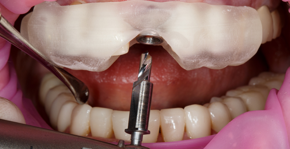 Хирургический шаблон для имплантации на модели челюсти