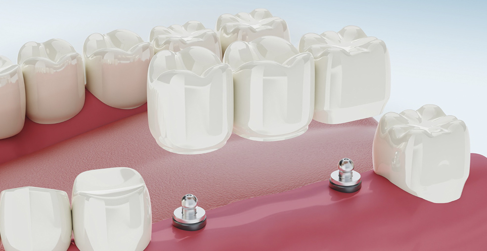 Схема мостовидного протеза на зубах