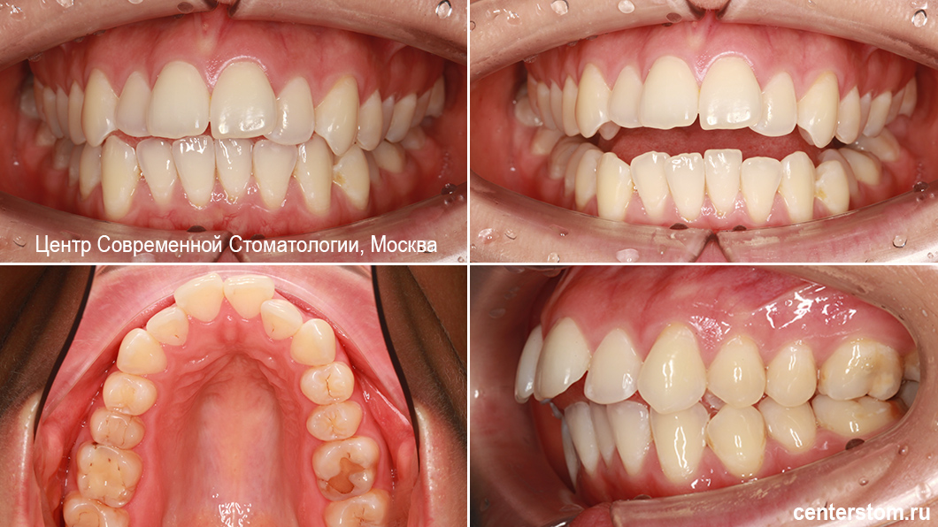 Выпирающие передние зубы, скученность, трудности с откусыванием пищи