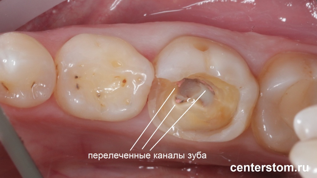Каналы зуба были перелечены. Этап терапевтической подготовки зуба к протезированию