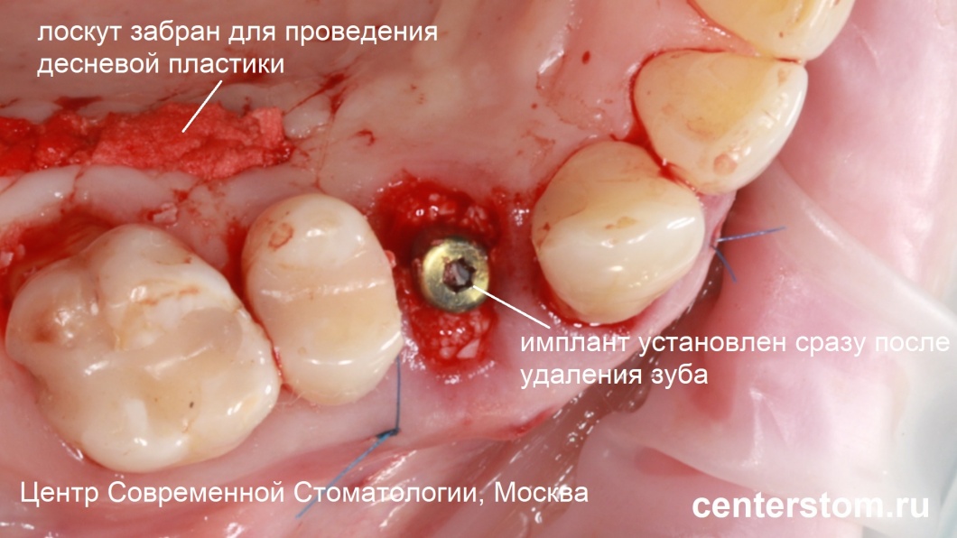 Имплант установлен сразу после удаления зуба
