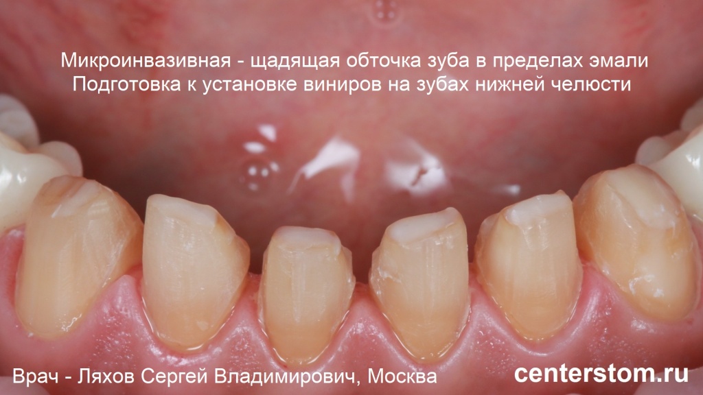 Грамотная обточка зубов должна всегда проводиться ТОЛЬКО в пределах эмали под виниры