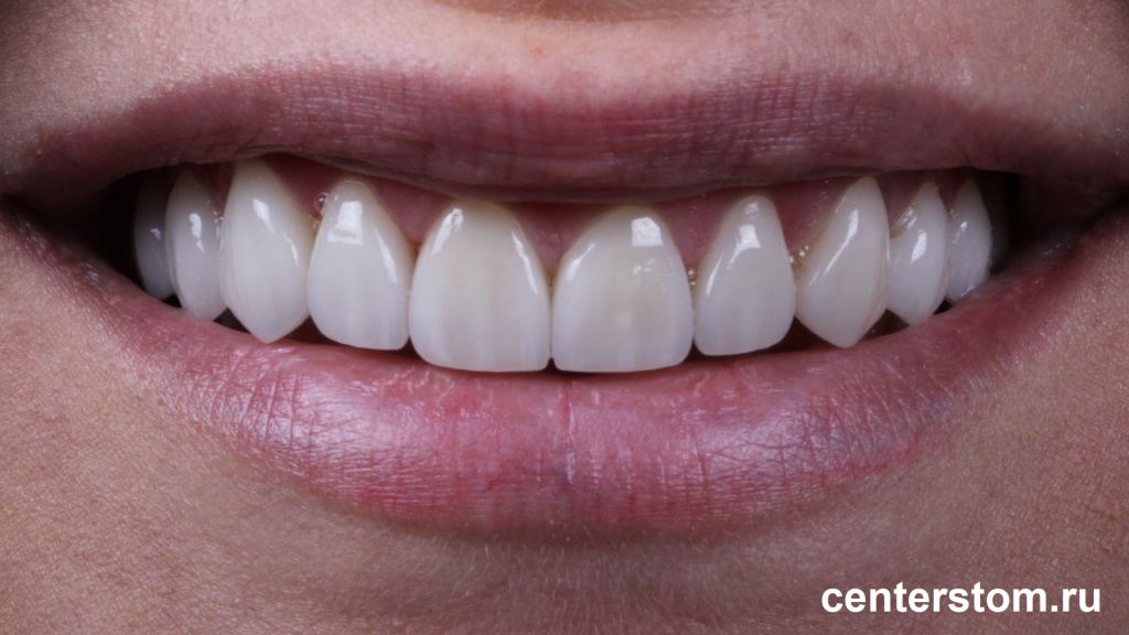 Керамические коронки на передние зубы - формирование зоны улыбки