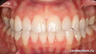 Фото после Выравнивание нижних зубов и центральной линии при скученности передних резцов