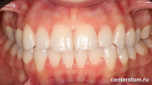 Выравнивание нижних зубов и центральной линии при скученности передних резцов