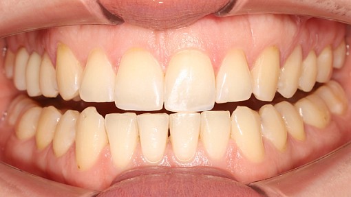 Как мы подготовили место для будущей коронки и устранили скученность зубов у взрослой пациентки всего за 1,5 года