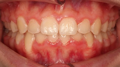 Фото после Защита детских зубов от стирания путем коррекции скученности у пациентки 11 лет