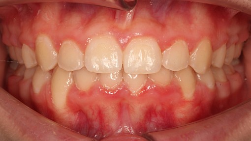 Защита детских зубов от стирания путем коррекции скученности у пациентки 11 лет