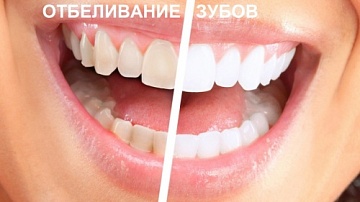 Отбеливание зубов в Москве: только передовые методики