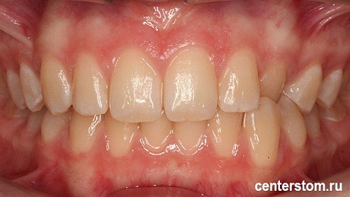 История улыбки: как мы помогли юной пациентке исправить положение клыка без брекетов и удаления зубов