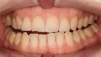 Фото до Как мы подготовили место для будущей коронки и устранили скученность зубов у взрослой пациентки всего за 1,5 года