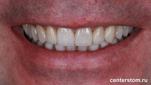 Пример как стираемость зубов перегрузила нижнечелюстной сустав. Лечение ВНЧС и восстановление зубного ряда