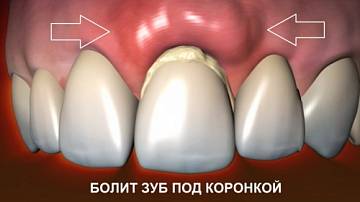 Болит зуб под коронкой: из-за чего, как устранить проблему