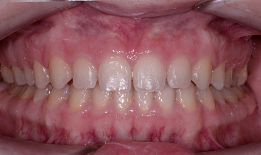 «Редкие зубы» - коррекция увеличенных межзубных промежутков и крупной диастемы между передними нижними резцами