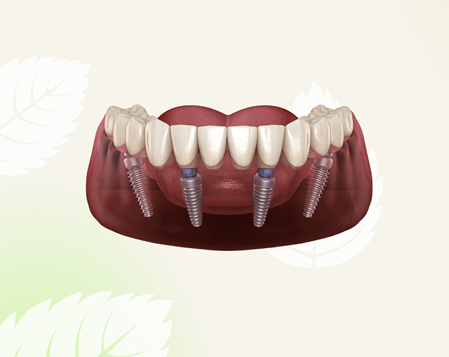 All-on-4 имплантация и протезирование зубов