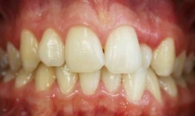 Фото до Перекрестное смыкание зубов в области резца верхней челюсти