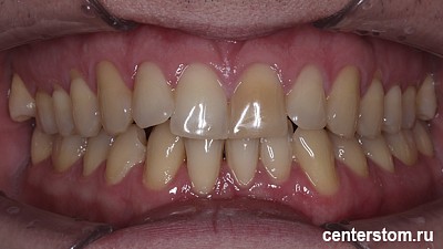 Фото до Мы выровняли зубы, сохранив здоровье дёсен - лечение пациента со склонностью к рецессии