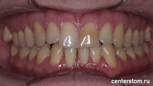 Мы выровняли зубы, сохранив здоровье дёсен - лечение пациента со склонностью к рецессии