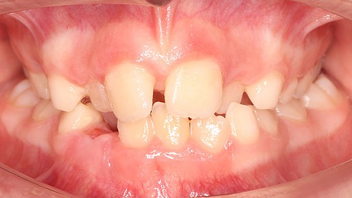 Раннее вмешательство: расширение челюсти в 9 лет, чтобы избежать сложностей в будущем