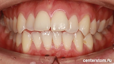 Фото до Мы исправили «детскую» проблему прикуса у взрослой пациентки