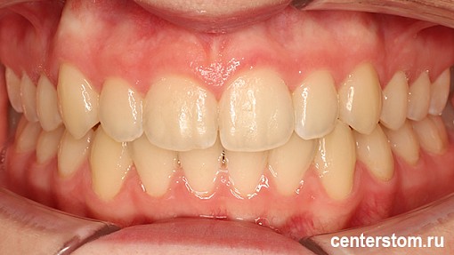 Как мы мягко расширили челюсти и освободили место для клыков, чтобы создать идеальную улыбку