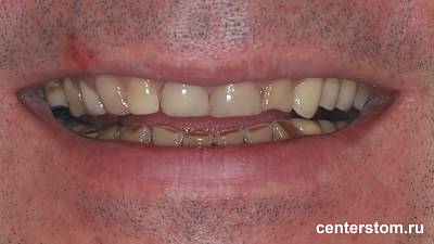 Фото до Пример как стираемость зубов перегрузила нижнечелюстной сустав. Лечение ВНЧС и восстановление зубного ряда