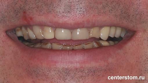 Пример как стираемость зубов перегрузила нижнечелюстной сустав. Лечение ВНЧС и восстановление зубного ряда