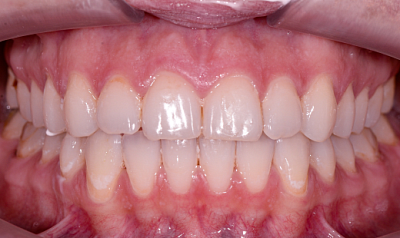 Фото после «Невидимое» лечение скученности зубов