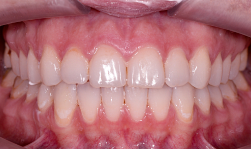 «Невидимое» лечение скученности зубов