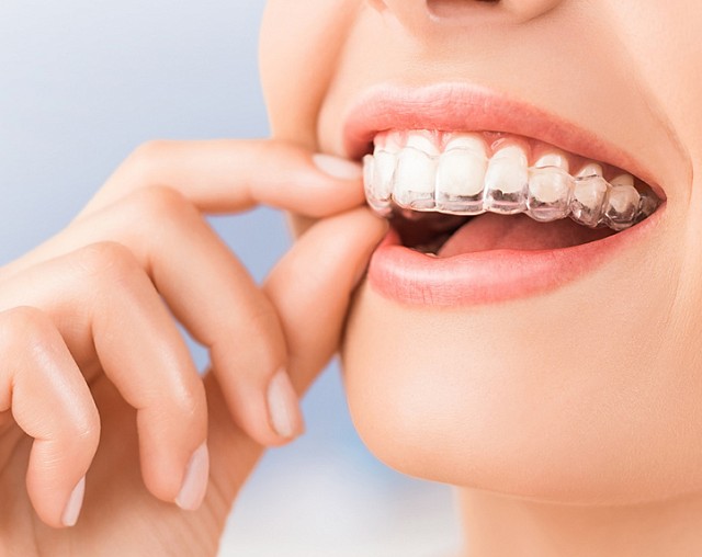 Элайнеры Spark в Москве — премиальное выравнивание зубов без брекетов