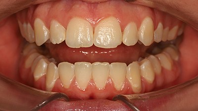 Фото после Командная работа: ортодонт и гнатолог на страже здоровья все полости рта