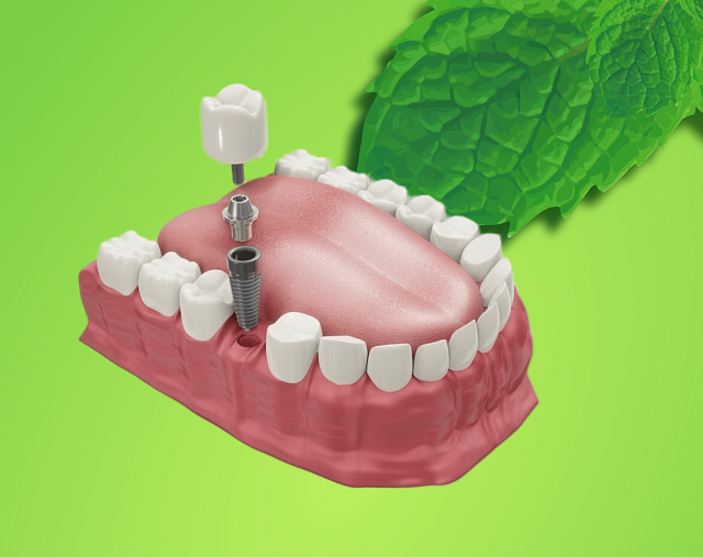 Зубные импланты с установкой под ключ