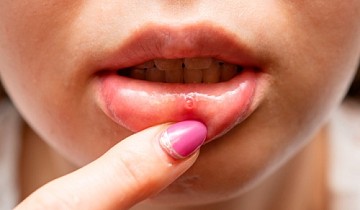 Стоматит: почему возникает и как его лечить?