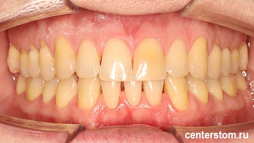 Мы выровняли зубы, сохранив здоровье дёсен - лечение пациента со склонностью к рецессии