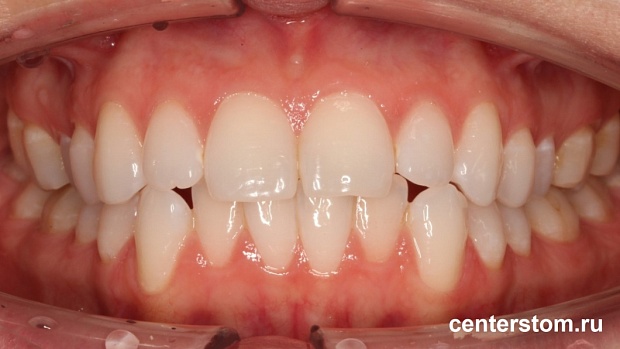 Фото до Выравнивание нижних зубов и центральной линии при скученности передних резцов